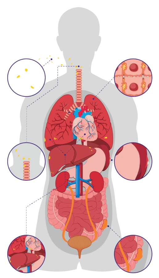 Infographic on how asbestos causes mesothelioma