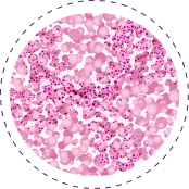 Epithelioid cell type