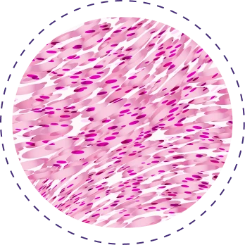 Sarcomatoid cell type